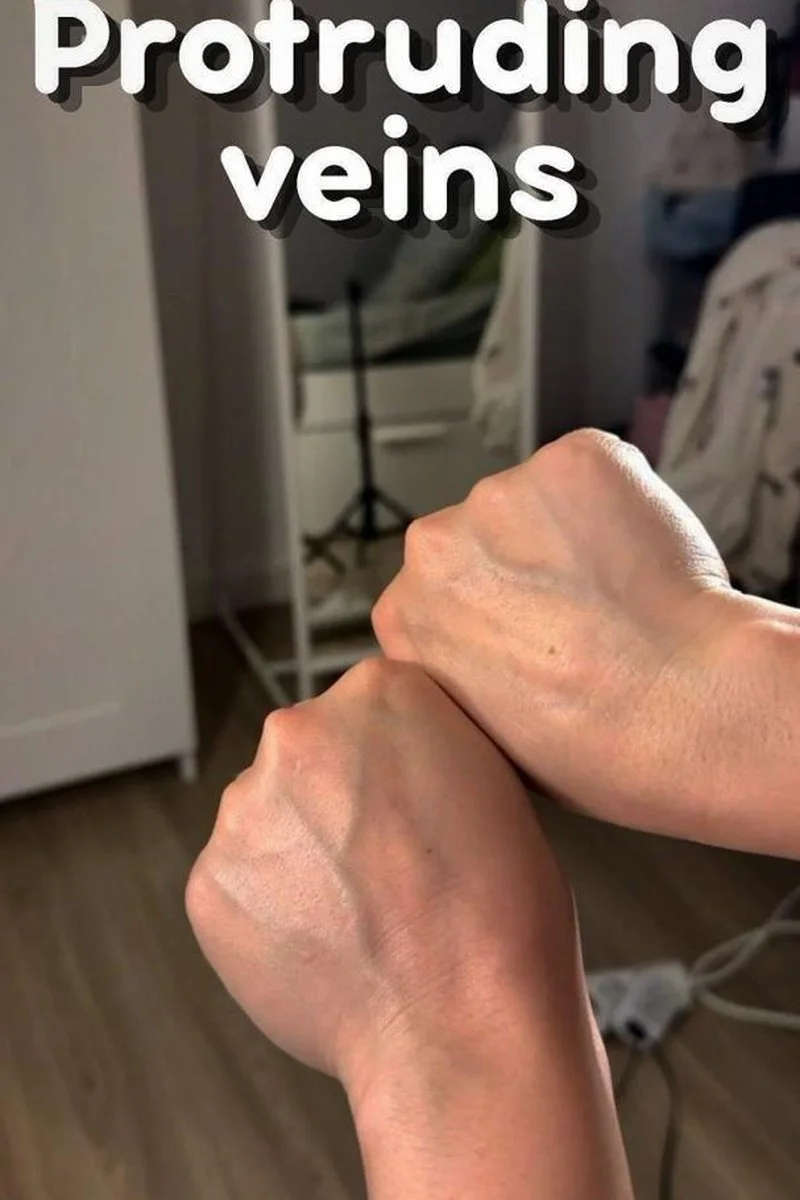 Protruding Veins